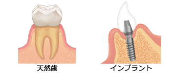 天然歯とインプラント比較